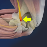 Elbow Arthroscopy Nowra | Tennis Elbow Treatment Nowra | Elbow Pain NSW
